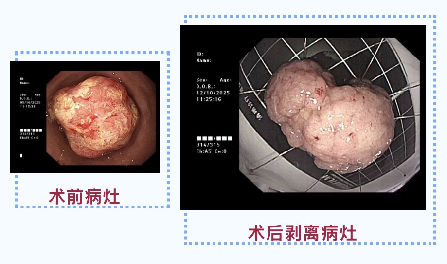 内镜微创“祛”肿瘤